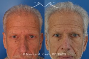 Photo of a patient before and after a procedure. 65 year old had noted a enlarging hard mass in the left upper forehead - This 65 year old who had noted a progressively enlarging hard mass in the left upper forehead. The clinical examination finding was consistent with an osteoma. The osteoma was successfully removed as an office procedure utilizing local anesthesia. The incision was perfectly hidden inside the hairline above the location of the osteom. The incision was designed to allow hair growth through the scar, thereby camouflaging it.