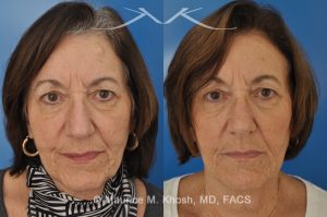 Photo of a patient before and after a procedure. Osteoma Removal - 68 year old lady interested in osteoma removal in Manhattan. Problem: Hard, round, raised mass underneath the forehead skin. Procedure: Osteoma removal as an office procedure, under local anesthesia.