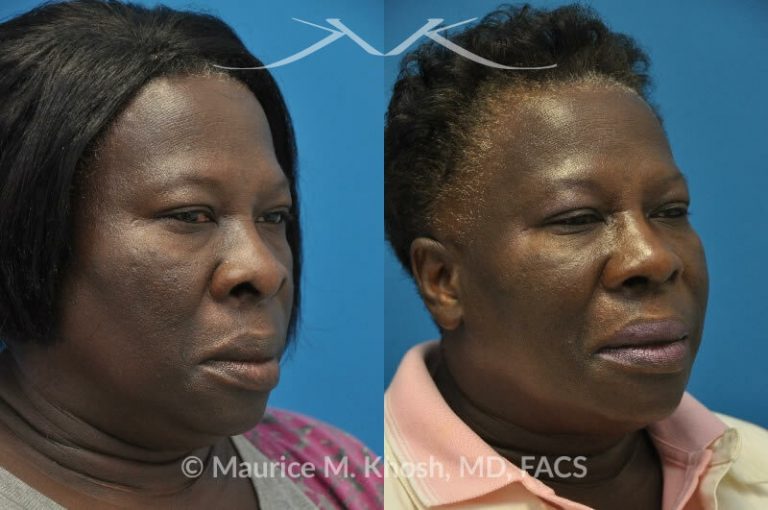 New York African American Rhinoplasty | Maurice M. Khosh MD, FACS NYC