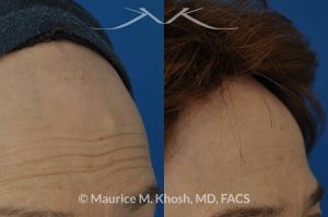 Photo of a patient before and after a procedure. Forehead osteoma, forehead bony hump