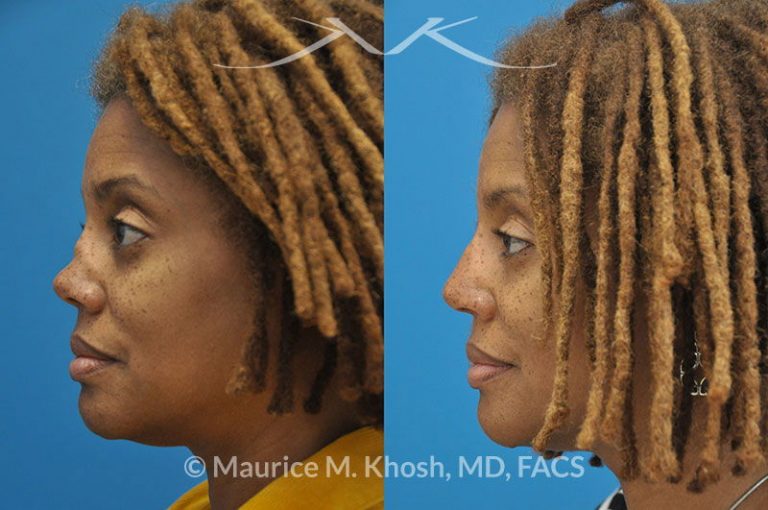 nyc-flat-nasal-bridge-nose-correction-surgery-new-york-rhinoplasty