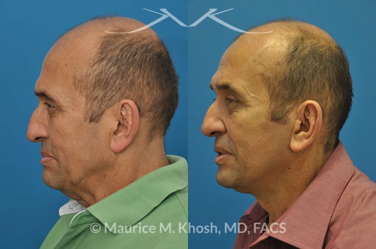 Male Neck Lift Surgery New York NY   265 768x510 