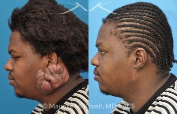 New York NY Doctor for Keloid Scar Surgery