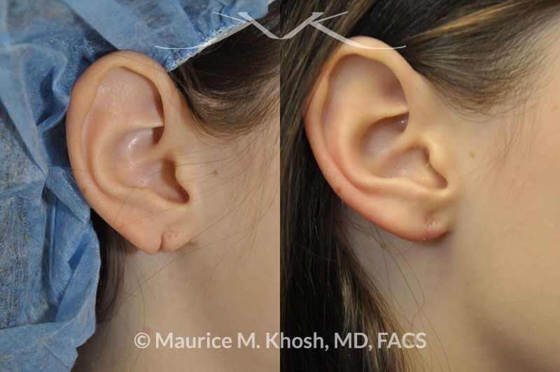 earlobe torn before repair surgery plastic facial york