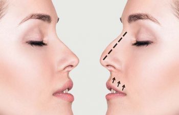 New York NY Surgeon for Revision Nose Job