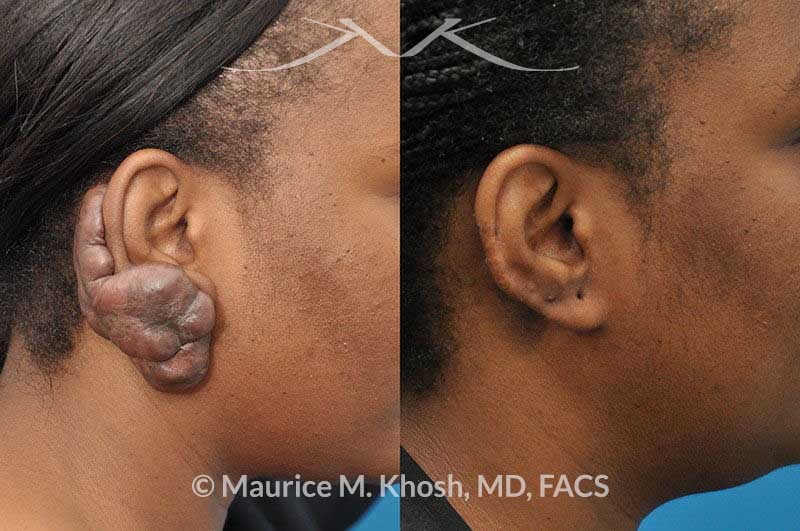 Management of Keloid Scars caused by Ear Piercings  Appearance Center