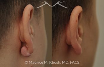 Keloid scar removal from the back side of the earlobe - before and after.