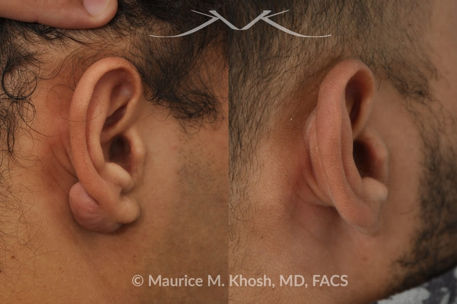 ear surgery scar