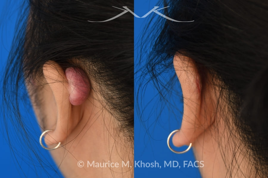Keloid Scar Revision Surgery At The Private Clinic London  Birmingham