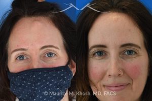 Photo of a patient before and after a procedure. Osteoma Removal - This 43 year old sought treatment for forehead osteoma in our New York office. She had the osteoma present for 20 years. The osteoma removal was performed in the office under local anesthesia. 

