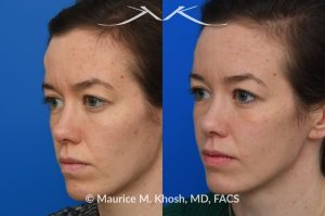 Photo of a patient before and after a procedure. Osteoma Forehead - The bony hump in the right upper forehead (an osteoma) was successfully treated through a hairline incision with a perfectly hidden scar within the hairline.