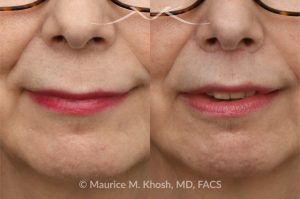Photo of a patient before and after a procedure. Lip lift