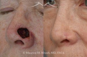 Photo of a patient before and after a procedure. Mohs repair of lower nose
