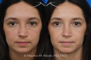 Photo of a patient before and after a procedure. Mole on the left cheek and right side of the nose
