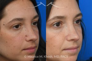 Photo of a patient before and after a procedure. Mole on the left cheek and right side of the nose