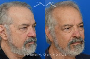Photo of a patient before and after a procedure. Osteoma