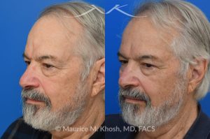 Photo of a patient before and after a procedure. Osteoma