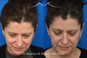 Photo of a patient before and after a procedure. Osteoma