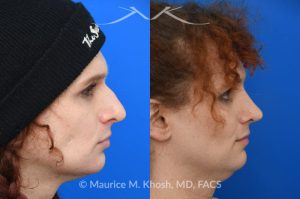 Photo of a patient before and after a procedure. Rhinoplasty to reduce hump and refine nasal tip 