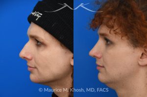 Photo of a patient before and after a procedure. Rhinoplasty to reduce hump and refine nasal tip 