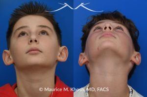 Photo of a patient before and after a procedure. Otoplasty - Otoplasty procedure, before and after photos.