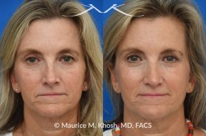 Photo of a patient before and after a procedure. Upper blepharoplasty - Upper blepharoplasty and rhinoplasty to decrease nasal tip projection. 