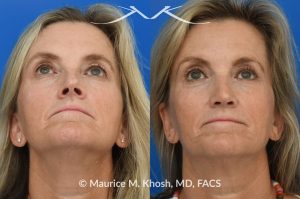 Photo of a patient before and after a procedure. Upper blepharoplasty - Upper blepharoplasty and rhinoplasty to decrease nasal tip projection. 