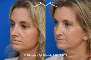 Photo of a patient before and after a procedure. Upper blepharoplasty - Upper blepharoplasty and rhinoplasty to decrease nasal tip projection. 