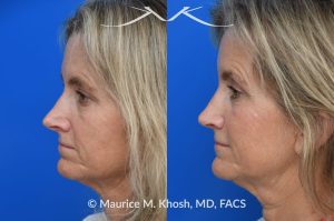 Photo of a patient before and after a procedure. Upper blepharoplasty - Upper blepharoplasty and rhinoplasty to decrease nasal tip projection. 