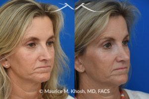 Photo of a patient before and after a procedure. Upper blepharoplasty - Upper blepharoplasty and rhinoplasty to decrease nasal tip projection. 