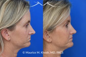 Photo of a patient before and after a procedure. Upper blepharoplasty - Upper blepharoplasty and rhinoplasty to decrease nasal tip projection. 