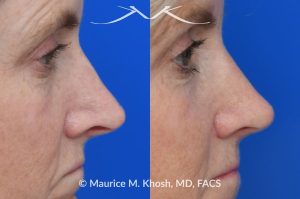 Photo of a patient before and after a procedure. Upper blepharoplasty - Upper blepharoplasty and rhinoplasty to decrease nasal tip projection. 