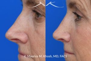 Photo of a patient before and after a procedure. Upper blepharoplasty - Upper blepharoplasty and rhinoplasty to decrease nasal tip projection. 