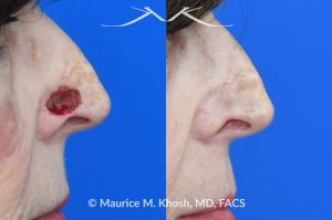 Photo of a patient before and after a procedure. Full thickness skin graft to repair a Mohs defect in the lower nose