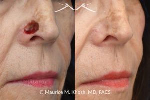 Photo of a patient before and after a procedure. Full thickness skin graft to repair a Mohs defect in the lower nose - before and after photos.