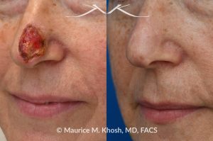 Photo of a patient before and after a procedure. Full thickness skin graft to repair a Mohs defect in the lower nose - before and after photos.