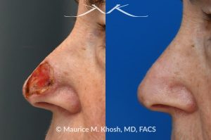 Photo of a patient before and after a procedure. Full thickness skin graft to repair a Mohs defect in the lower nose - before and after photos.