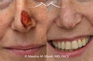 Photo of a patient before and after a procedure. Full thickness skin graft to repair a Mohs defect in the lower nose