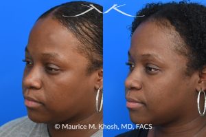 Photo of a patient before and after a procedure. Osteoma of left forehead - photo before and after procedure.