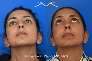 Photo of a patient before and after a procedure. Right sided nasal valve repair - Right sided nasal valve repair with bilayered spreader graft. Columellar strut to support the nasal tip.