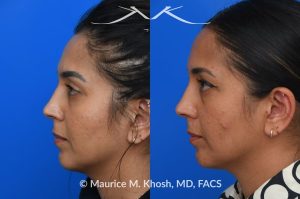 Photo of a patient before and after a procedure. Right sided nasal valve repair - Right sided nasal valve repair with bilayered spreader graft. Columellar strut to support the nasal tip.