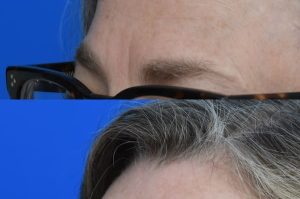 Photo of a patient before and after a procedure. Right upper forehead Osteoma - photo before and after procedure.