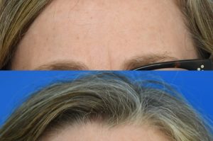 Photo of a patient before and after a procedure. Right upper forehead Osteoma - photo before and after procedure.