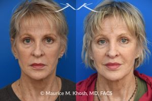 Photo of a patient before and after a procedure. Lip Lift