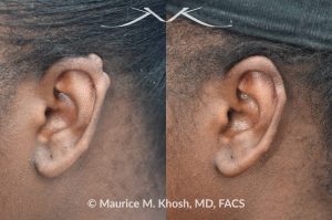 Photo of a patient before and after a procedure. Keloid scar on upper left ear  - photo before and after removal.