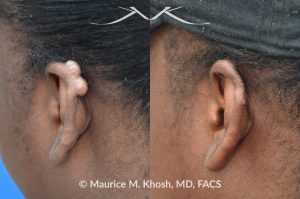 Photo of a patient before and after a procedure. Keloid scar on upper left ear  - photo before and after removal.