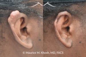 Photo of a patient before and after a procedure. Keloid scar on upper right ear  - photo before and after removal.