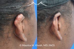 Photo of a patient before and after a procedure. Keloid scar on upper right ear  - photo before and after removal.