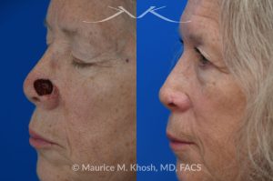 Photo of a patient before and after a procedure. Mohs repair of nose - Mohs excision of a basal cell carcinoma resulted in this large defect in the left lower nose. Initially a full thickness skin graft was used to resurface the nose. Following the skin graft, there was some contracture of the internal nose which compromised the patient's breathing. This problem was addressed with a composite (skin and cartilage graft) from the ear to inside of the nose. 