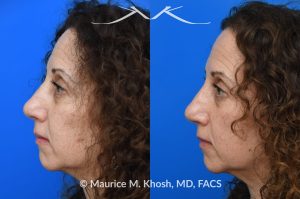 Photo of a patient before and after a procedure. Nose fracture, dorsal widening and deviaiton to the left side. - photo before and after repair.